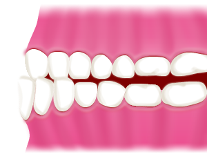 反対咬合とは？