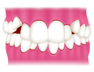 八重歯・叢生とは？